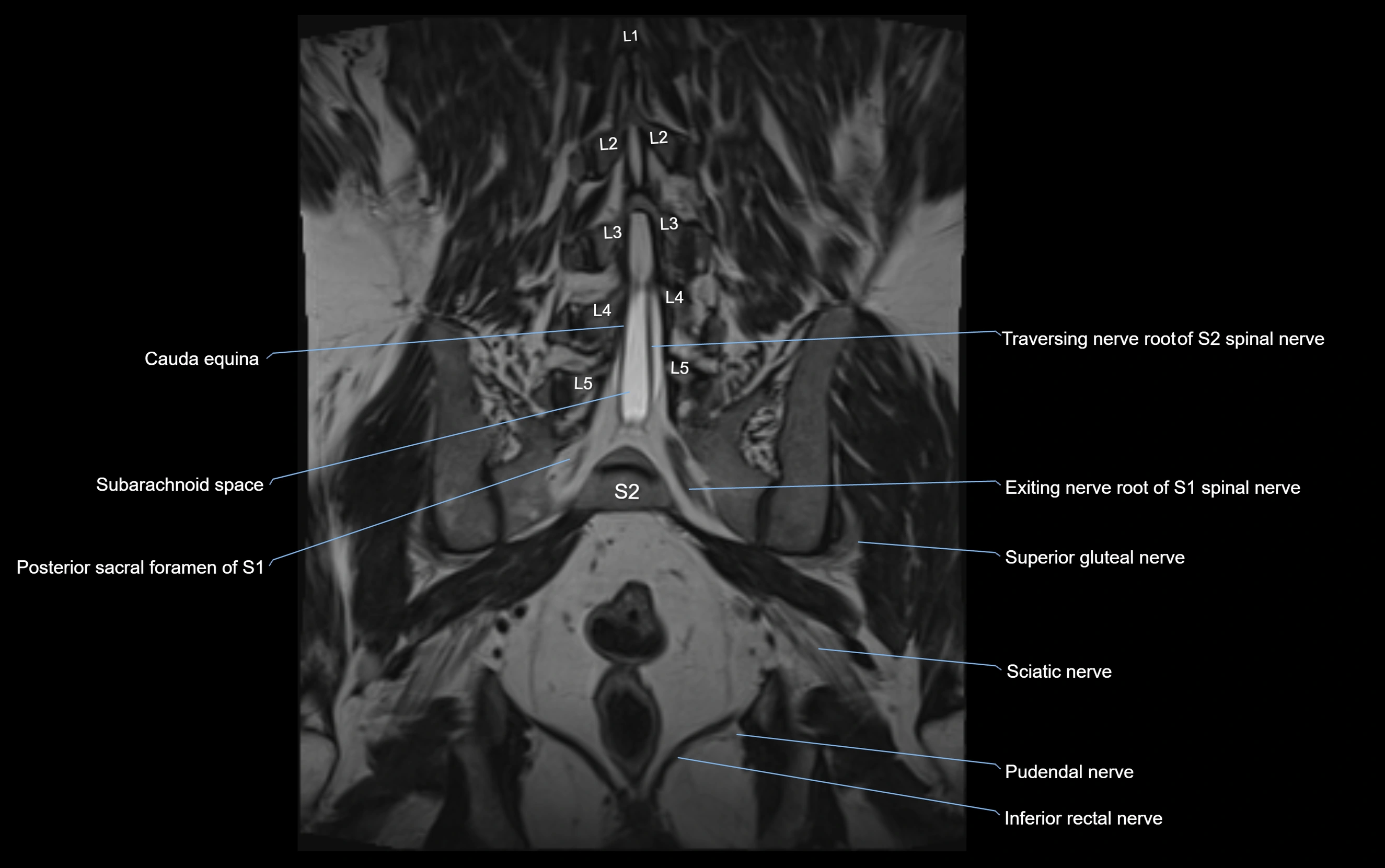 MR lumbosacral plexus cross sectional anatomy 3T  radiology  image-img-09001-00050.webp